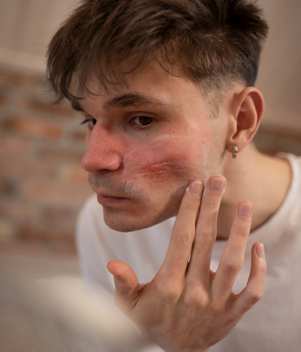 Symptoms and Signs of Rosacea Image