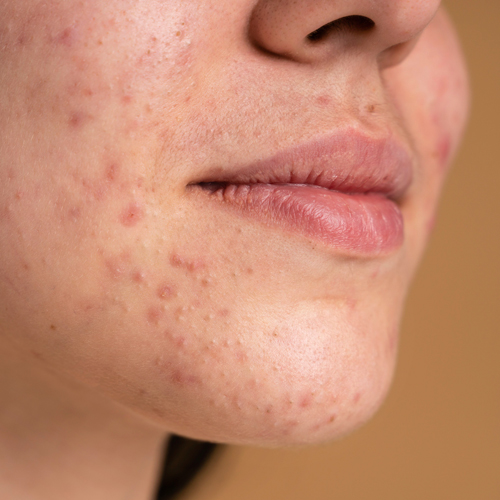 Atrophic Scars Image