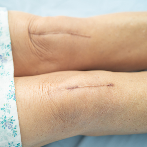 Contracture Scars Image