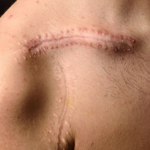 Hypertrophic Scars Image