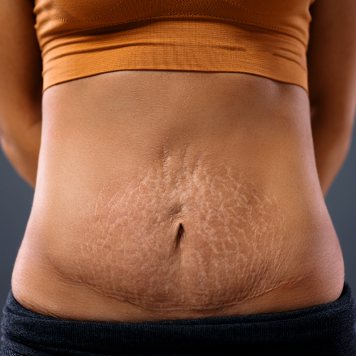 Stretch Marks (Striae) Image