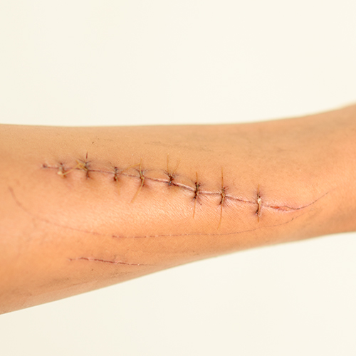 Post-Surgical Scars Image